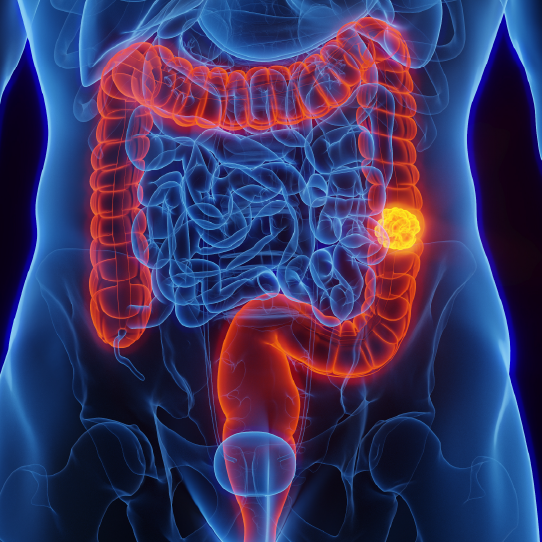 Bowel_cancer
