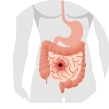 Cizumab_Gastrointestinal perforations