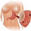 Hole in the stomach or intestines (perforation)
