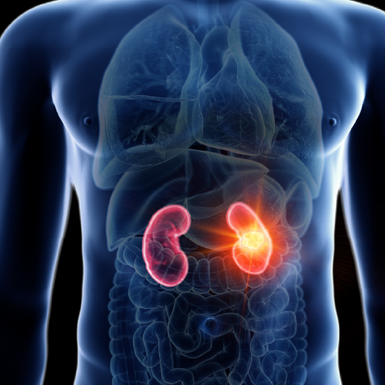 Kidney_cancer