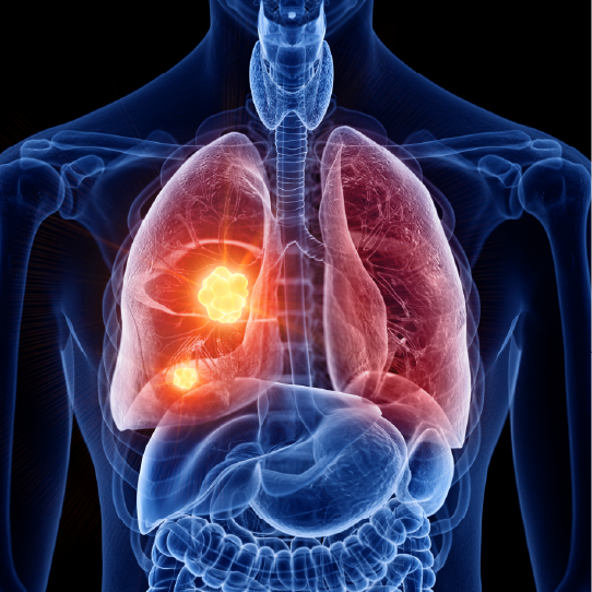 Lung_cancer